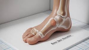 Bone Spur on Top of Foot